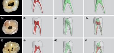 Endodontic access cavity preparation size. Does it affect instrumentation?