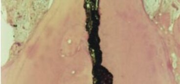 Apical limit of instrumentation and obturation. Are you an apical barbarian?
