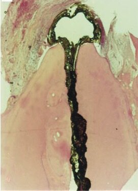 Apical limit of instrumentation and obturation. Are you an apical barbarian?