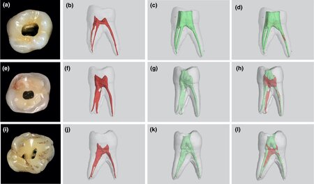 Endodontic access cavity preparation size. Does it affect instrumentation?