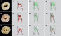 Endodontic access cavity preparation size. Does it affect instrumentation?